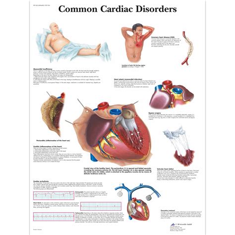 Common Cardiac Disorders Chart - 4006680 - VR1343UU - Cardiovascular System - 3B Scientific