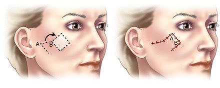 The Modified Rhomboid Flap: An Improvement on the Traditional Technique ...