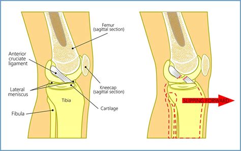 Anterior Cruciate Ligament Repair (ACL, MCL, MPFL, PCL, LCL) – Yellowstone Surgery Center