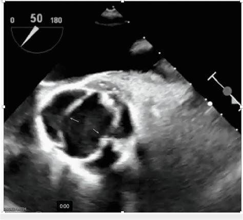 Figure 1 from Streptococcus sanguinis Endocarditis of Bicuspid Aortic Valve Presenting as Septic ...