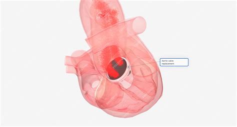 Premium Photo | Aortic valve replacement in the heart