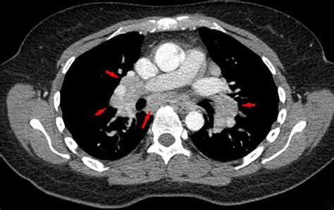 Sarcoidosis - Wikiwand