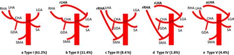 Schematic diagram of hepatic artery variation in the present study. a... | Download Scientific ...