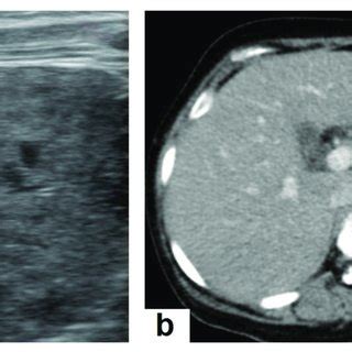 Miliary TB in an adult female with fatigue and loss of appetite. (a)... | Download Scientific ...