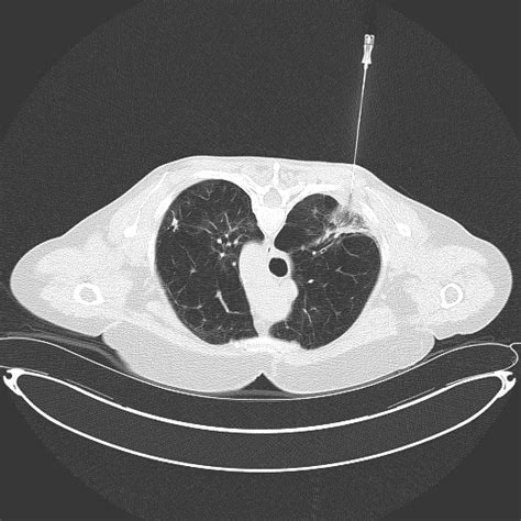 Percutaneous lung biopsy - Aspergillus and Aspergillosis