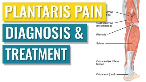 Plantaris Tendonitis - Symptoms and Treatment - YouTube