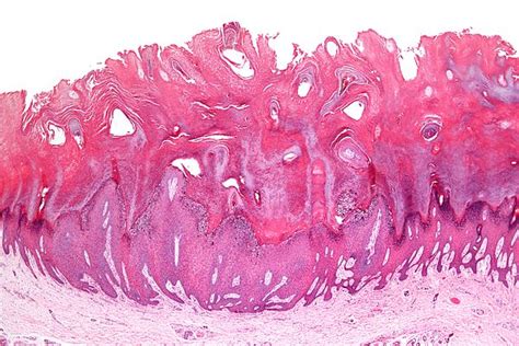 Verruca vulgaris - Libre Pathology