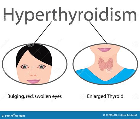 Neck With Enlarged Thyroid Gland Vector Illustration | CartoonDealer ...