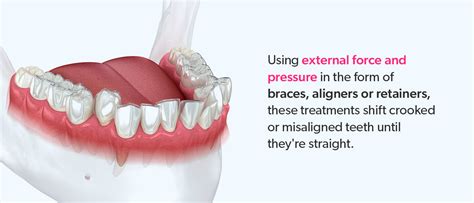 Breakdown of the Different Clear Aligner and Retainer Materials