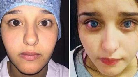 Africa’s First Eye Color Surgery Occurs in Morocco