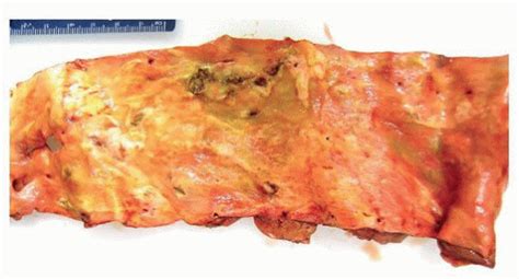 Thoracic Aortic Atherosclerosis | Thoracic Key