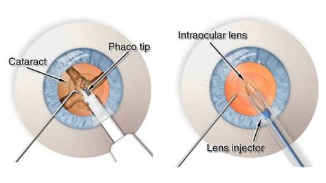 All About Phacoemulsification Procedure | OBN