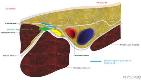 Clinical Practice Guidelines : Femoral Nerve Block