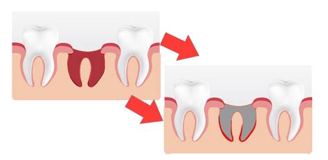 Dry Socket - Causes and Management