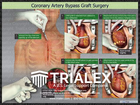 Coronary Artery Bypass Graft Surgry - TrialQuest Inc.