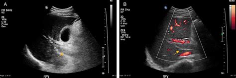 Thrombotic Venous Diseases of the Liver