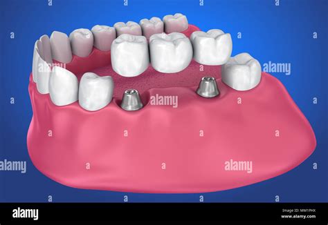 implant supported fixed bridge. Medically accurate 3D illustration Stock Photo - Alamy