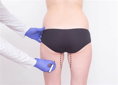 CoolSculpting For Slimming Inner & Outer Thighs