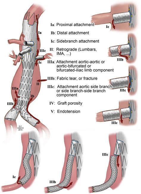 Outcomes of target vessel endoleaks after fenestrated-branched ...