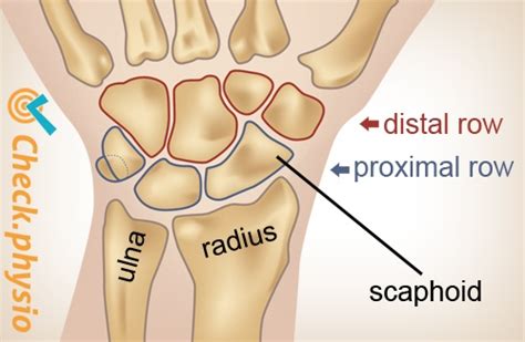 DISI deformity | Physio Check