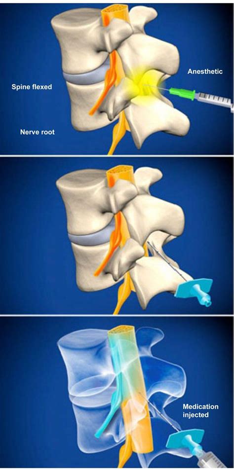 Lumbar Epidural Steroid Injection (without contrast) - Plano, TX: Advanced Spine Center