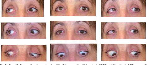 Figure 1 from Partial third cranial nerve palsy: clinical characteristics and surgical ...