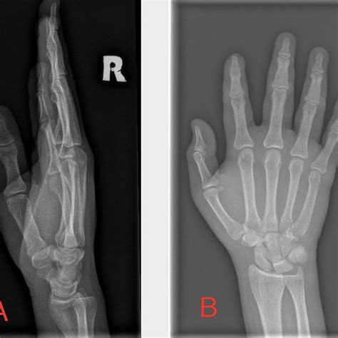 Right hand X-ray showing soft tissue swelling, no foreign body noted.... | Download Scientific ...