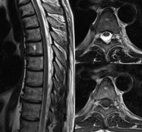 MRI of the thoracic spine after removal of the knife showing normal... | Download Scientific Diagram