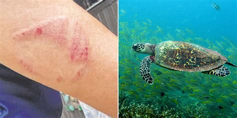 S'pore Lady Bitten By Sea Turtle While Snorkelling In M'sia, Suffers Abrasion On Arm