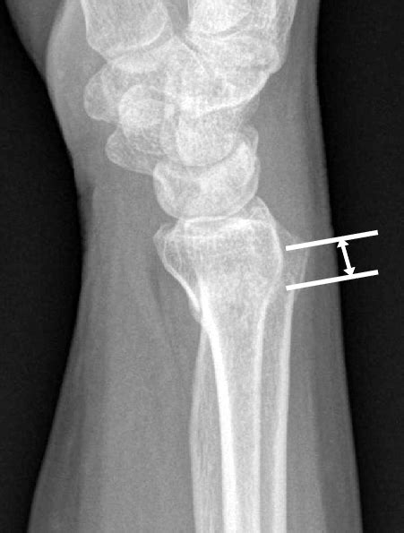 Distance from Lister's tubercle to the fracture line is measured from ...