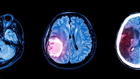 Tumor Cerebral - Neuronrehab