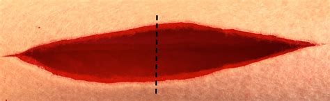 Veterinary Key Points: Closure of Elliptical Incisions in Dogs: The "Rule of Halves"