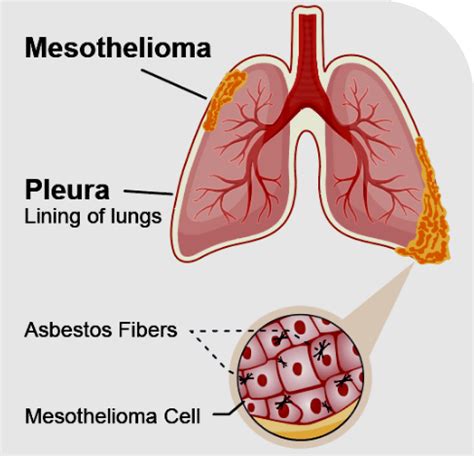 Pleural Mesothelioma - The Lanier Law Firm