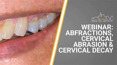 Webinar: Abfractions, Cervical Abrasion & Cervical Decay - Geriatric House Call Dentistry