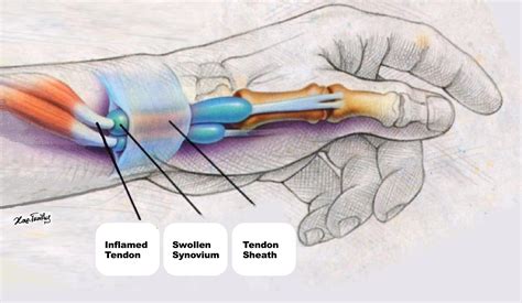 De Quervain Syndrome / Tenosynovitis - Hand Pain Info