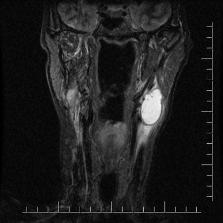 Infected second branchial cleft cyst | Image | Radiopaedia.org