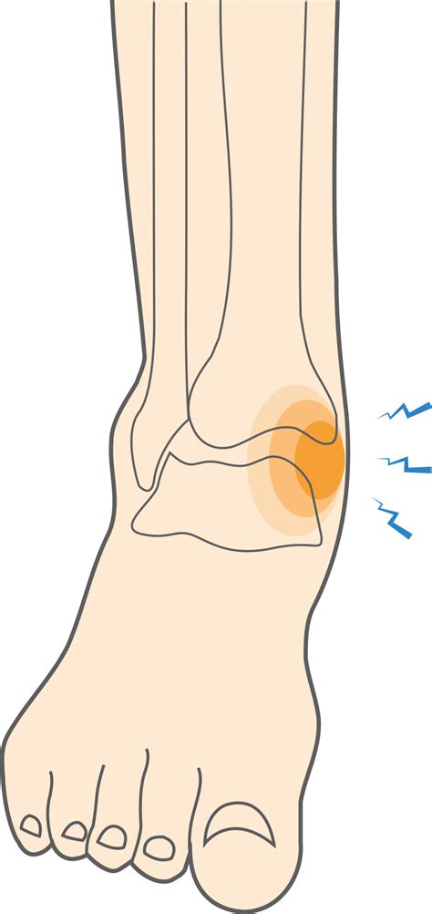 Deltoid Ligament Ankle Sprain