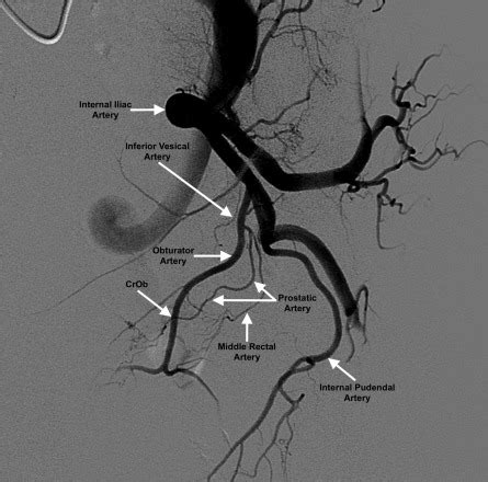 Crossing Obturator Sign: Angiographic Feature to Aid Prostatic Artery Identification - Journal ...