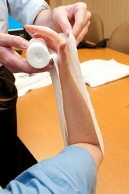 Sugar-Tong Forearm Splinting Technique: Application of Sugar-Tong Splint, Postprocedural Care ...