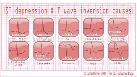 ECG Educator Blog : ST depression & T wave inversion causes