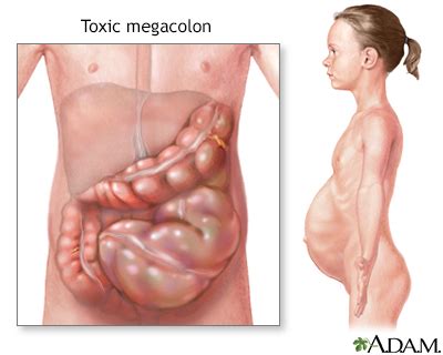 Toxic megacolon Information | Mount Sinai - New York