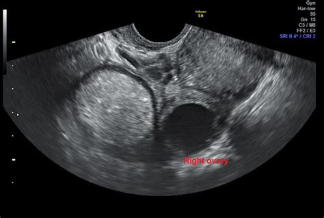 Dermoid Cyst || Ultrasound || Case 164, 57% OFF