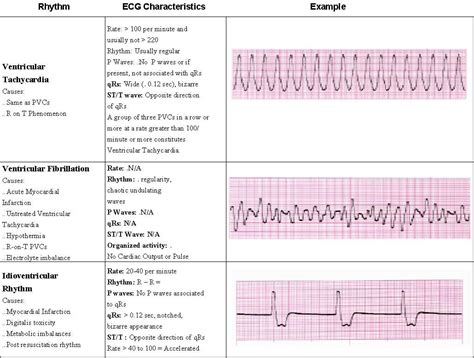 ACLS Rhythms pg 5 of 7 Ekg Rhythms, Cardiac Rhythms, Heart Rhythms, Acls Study Guide, Study Info ...