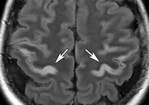 Imaging Patterns of Toxic and Metabolic Brain Disorders | RadioGraphics