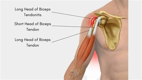 Long Head of Biceps Tendonitis: Symptoms and Exercises for LHB