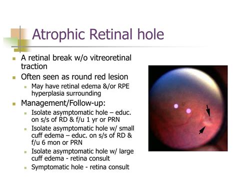 Atrophic Retinal Hole