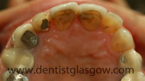 Dental Implants and Porcelain Bonded Crown | Glasgow Case Study