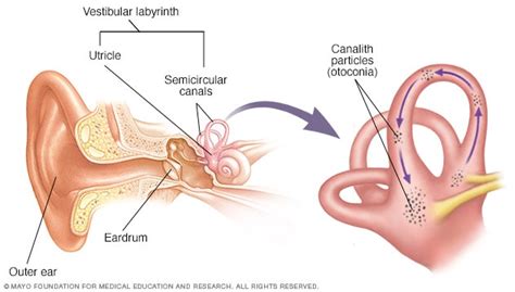 Benign paroxysmal positional vertigo (BPPV) - Diagnosis and treatment - Mayo Clinic