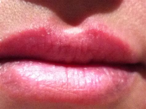 my upper lip..very small red rash & swelling..psoriasis..lip balm..Lip