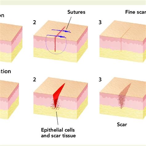 Difference in wound healing between primary and secondary intention closure | Download ...